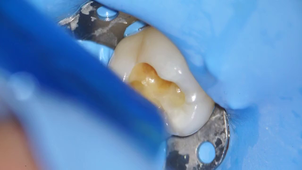 Dr Savouré - Odontologie conservatrice